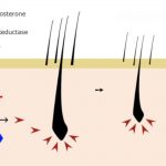 Tutto quello che c’è da sapere su DHT e perdita di capelli DHT