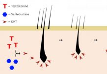 Tutto quello che c’è da sapere su DHT e perdita di capelli DHT
