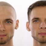 C’è davvero una cura per la calvizie? cura-calvizie