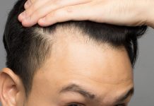 Diventerà calvo? Come raccontare il tuo futuro follicolare.