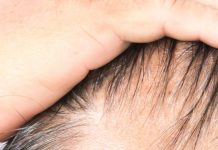 A che età è troppo giovane per un trapianto di capelli? età trapianto