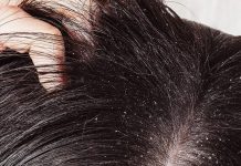 forfora-perdita-capelli