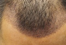 nascondere trapianto