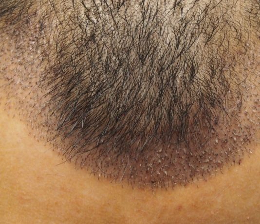 Devo tenere nascosto il mio trapianto di capelli? nascondere trapianto