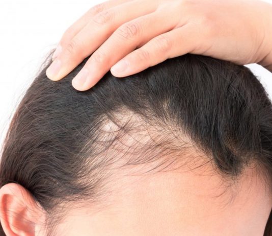 perdita-capelli-donna