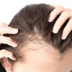 Calvizie femminili e tipologie di diradamento perditacapellidonna